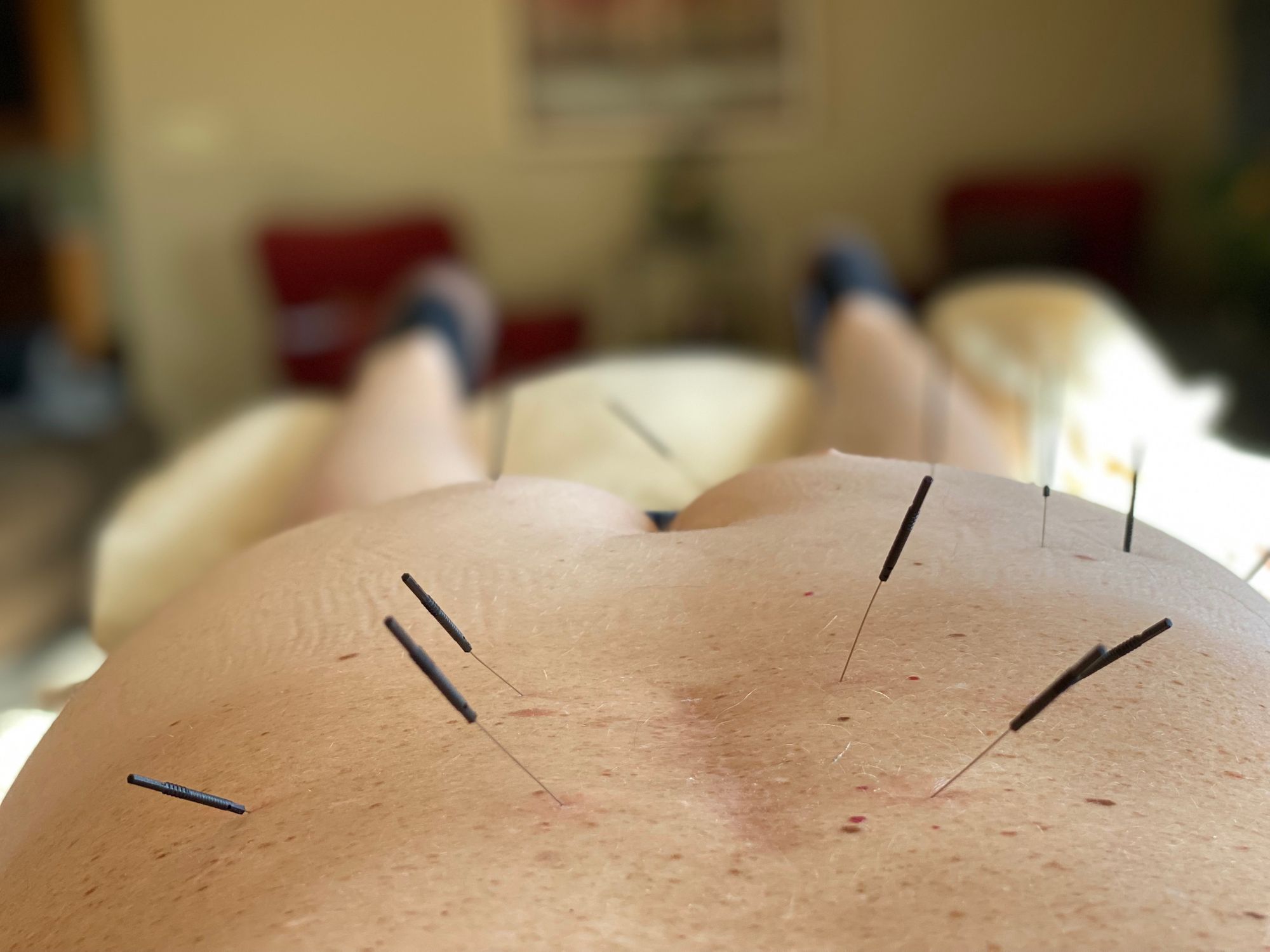 Pelvic Floor Dry Needling What Is It Who Can Do It Intricate Art