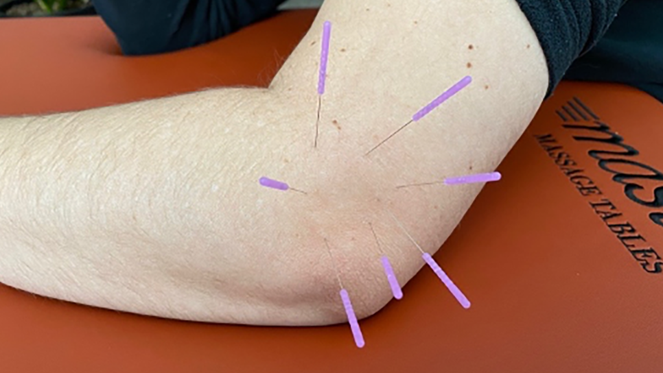 Dry Needling for Epicondylitis: Can it help?