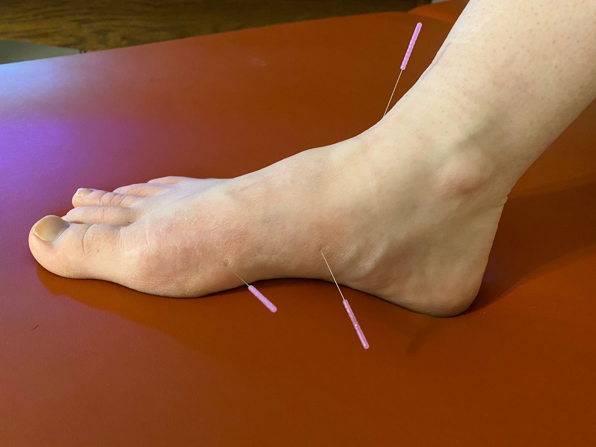 Acupuncture Knee Arthritis Pain Relief Confirmed
