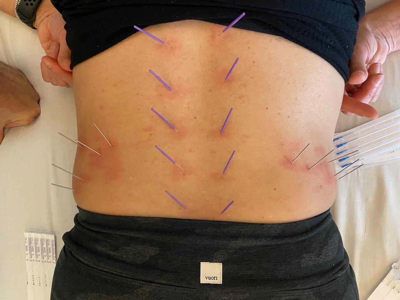 Can Dry Needling Help with Neurological Conditions?