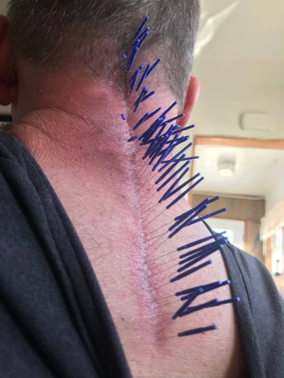 Dry Needling Scar Tissue to Regulate the Autonomic Nervous System