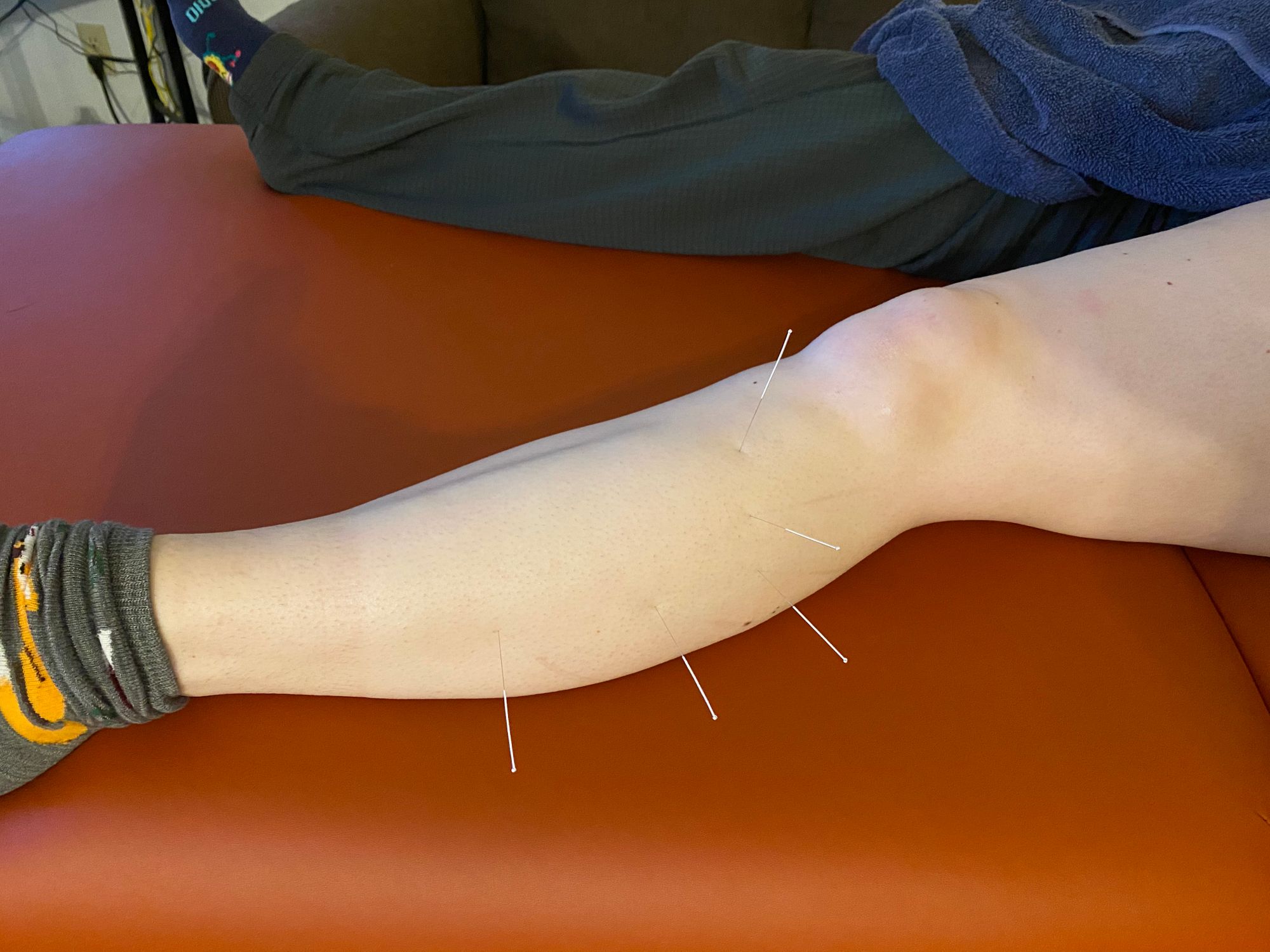 Dry needling with electrical stimulation side effects