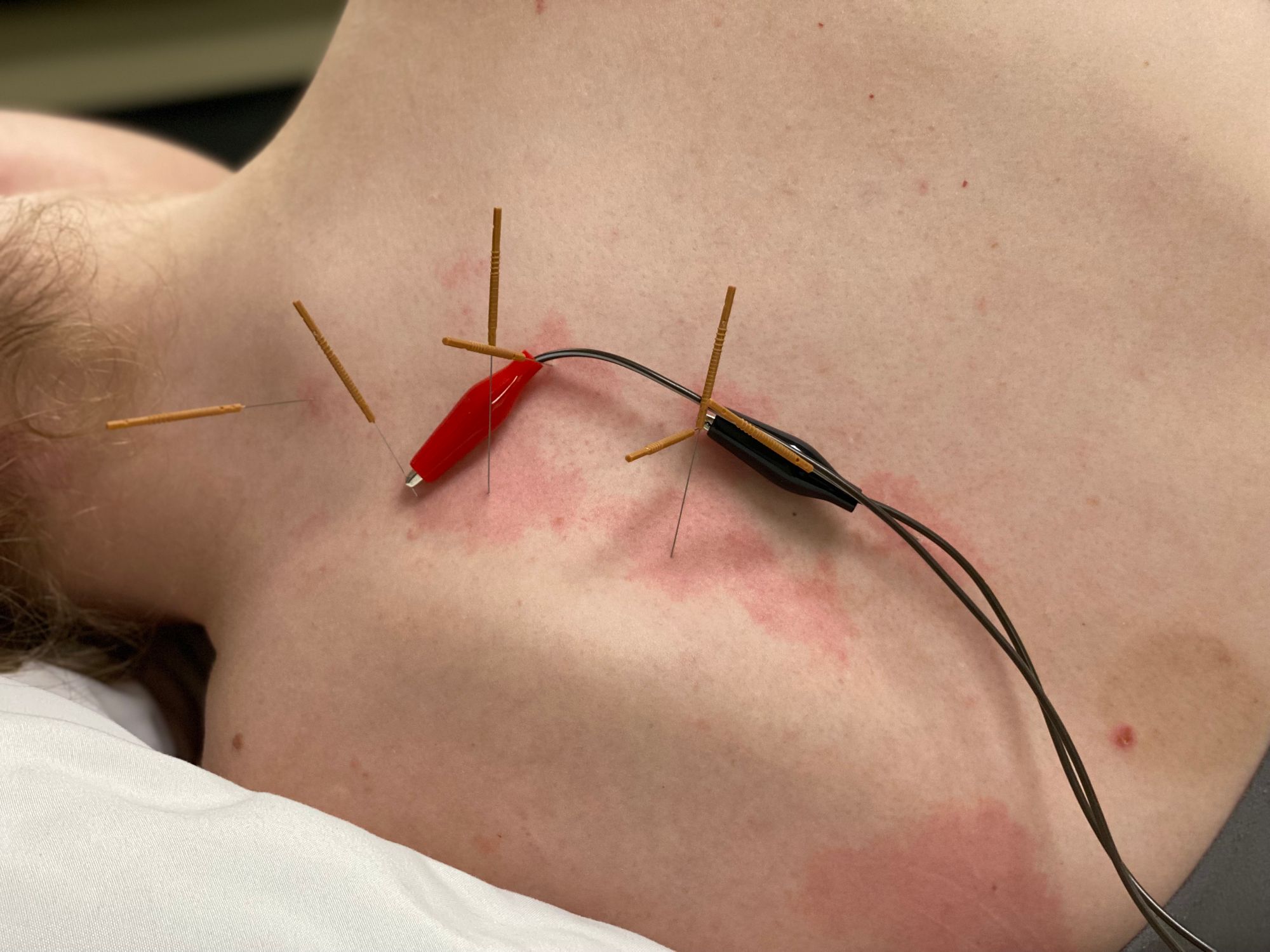 Does dry needling actually work?